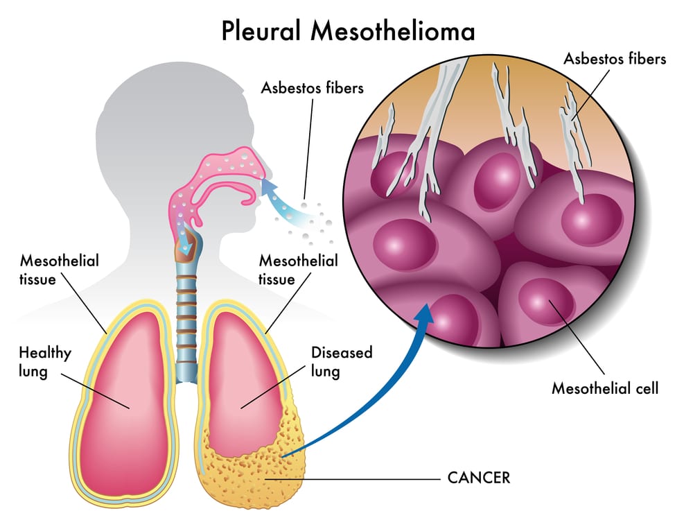 Pleural Mesothelioma Image
